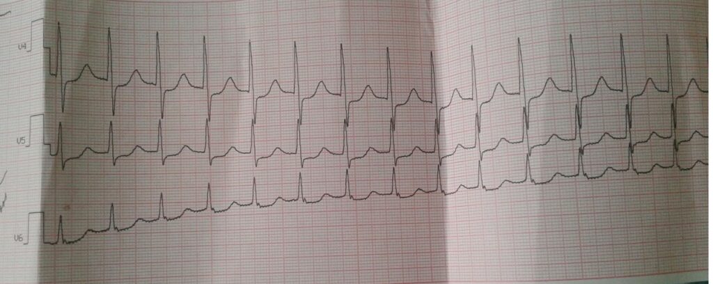 Фото 22 — Тахикардия: причины и методы лечения