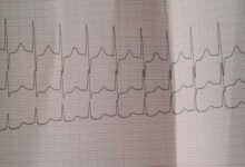 Photo of Тахикардия: причины и методы лечения