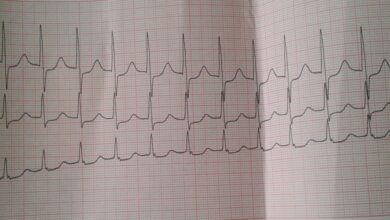 Photo of Тахикардия: причины и методы лечения
