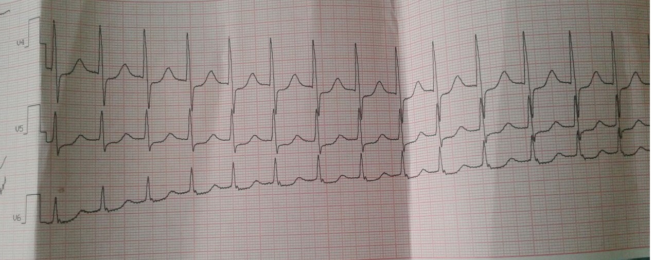 Фото 22 — Тахикардия: причины и методы лечения