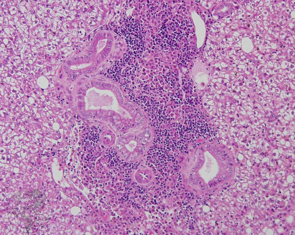 Фото 19 — Эндокардит: опасное воспалительное заболевание сердца