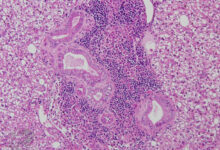 Photo of Эндокардит: опасное воспалительное заболевание сердца