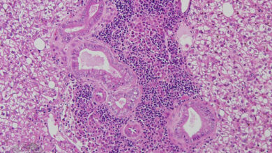 Photo of Эндокардит: опасное воспалительное заболевание сердца