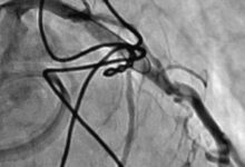 Photo of Ревматическая болезнь сердца: последствия для здоровья