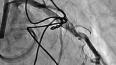 Photo of Ревматическая болезнь сердца: последствия для здоровья