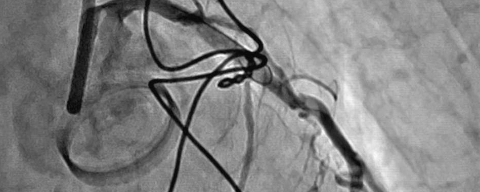 Фото 31 — Ревматическая болезнь сердца: последствия для здоровья