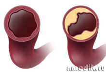 Photo of Что такое атеросклероз: симптомы и методы лечения