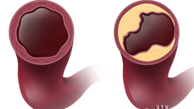 Photo of Что такое атеросклероз: симптомы и методы лечения