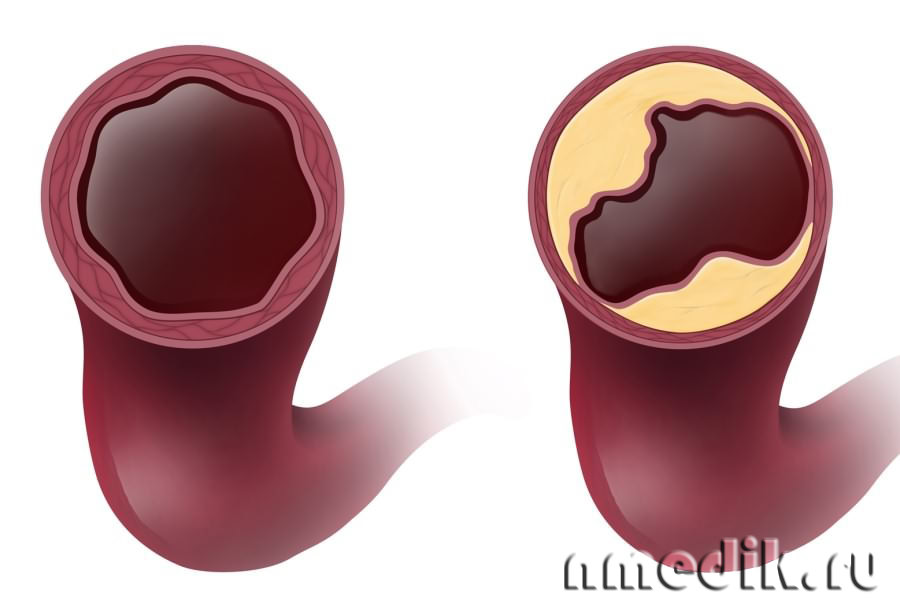 Фото 40 — Что такое атеросклероз: симптомы и методы лечения