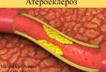 Photo of Как избежать развития атеросклероза: эффективные методы профилактики