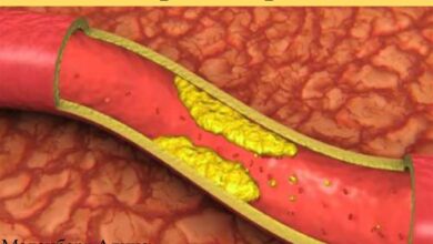 Photo of Как избежать развития атеросклероза: эффективные методы профилактики