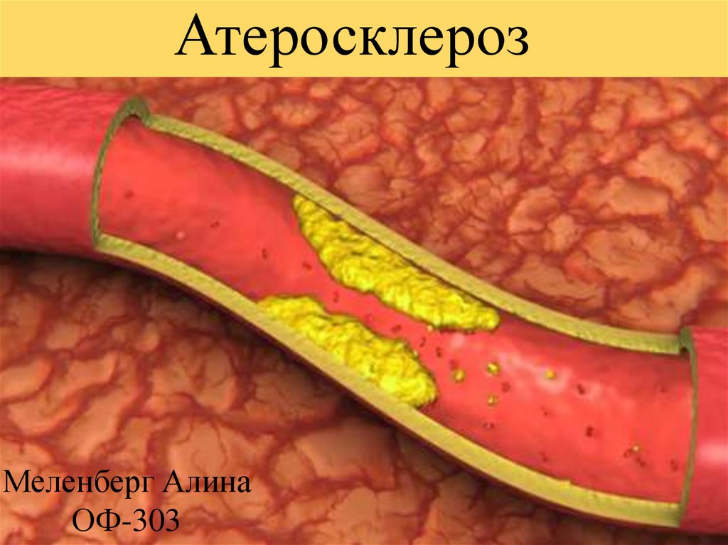 Фото 11 — Как избежать развития атеросклероза: эффективные методы профилактики