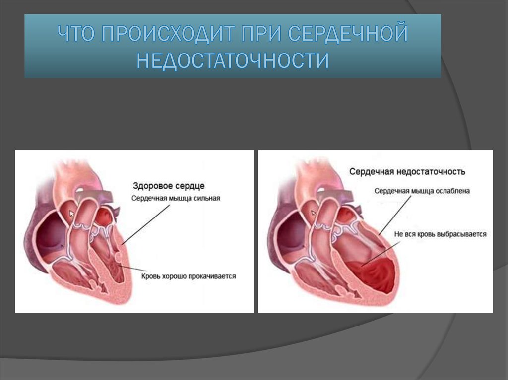 Фото 7 — Признаки сердечной недостаточности: как их распознать