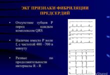 Photo of Фибрилляция предсердий: опасное нарушение ритма