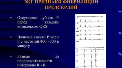 Photo of Фибрилляция предсердий: опасное нарушение ритма